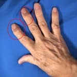 manos con artritis