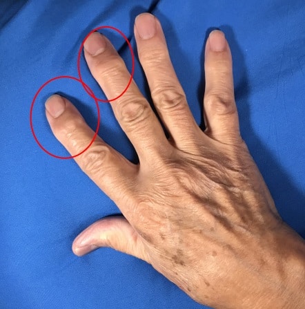manos con artritis