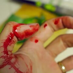 Herida en la mano